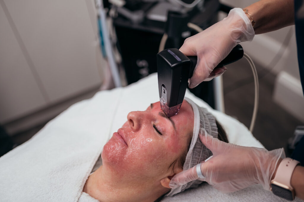 The Benefits of Radio Frequency Microneedling with Morpheus8