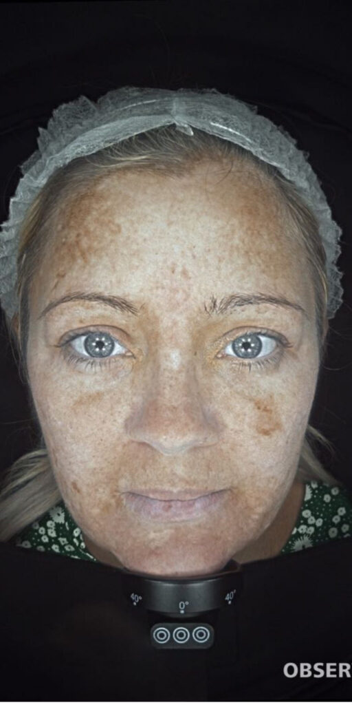 Melasma treatment in Hale