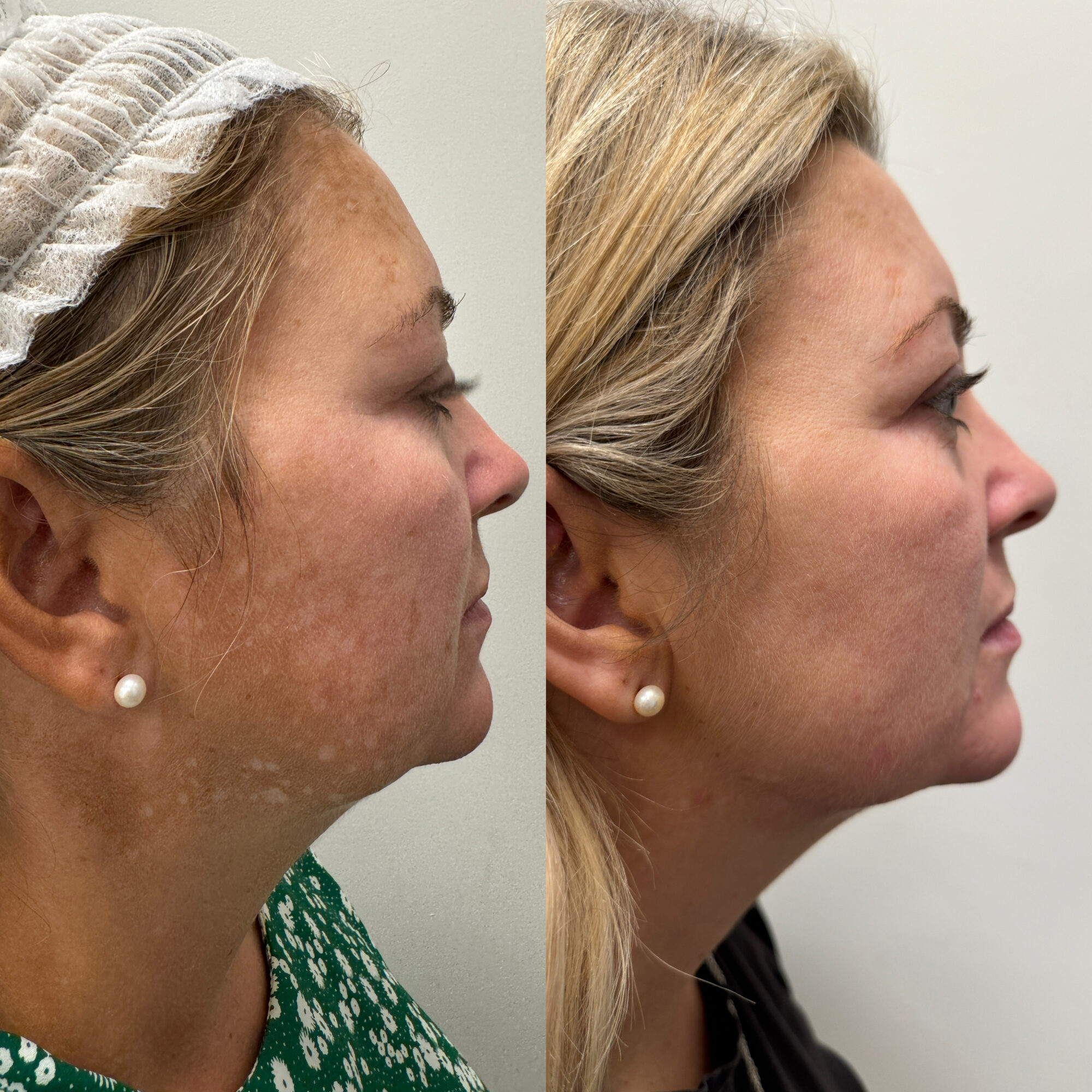 Melasma treatment in Hale