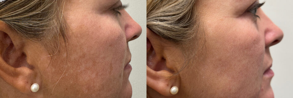 Melasma treatment in Hale