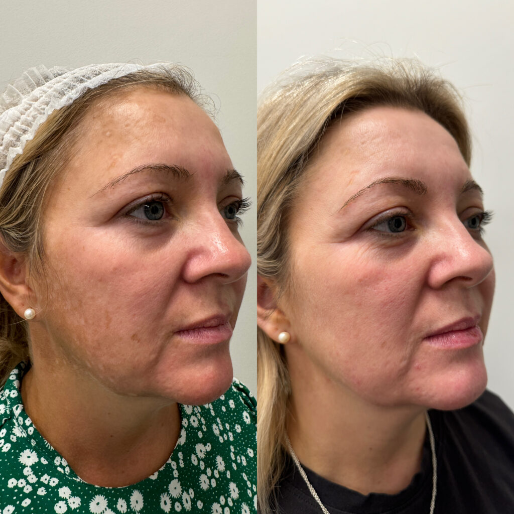 Melasma treatment in Hale