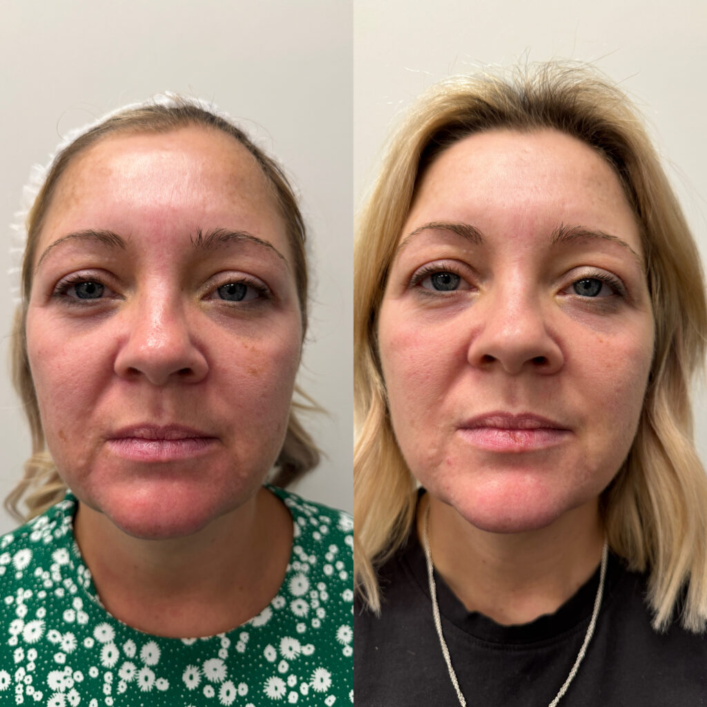 Melasma treatment in Cheshire