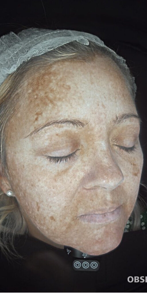 Melasma treatment in Hale